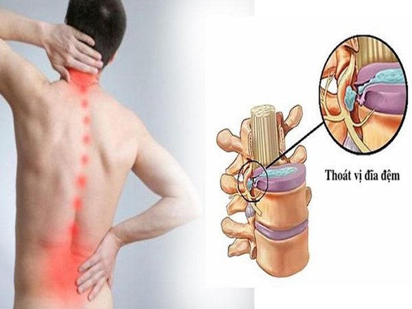 Bệnh thoát vị đĩa đệm có khỏi dứt điểm được không?