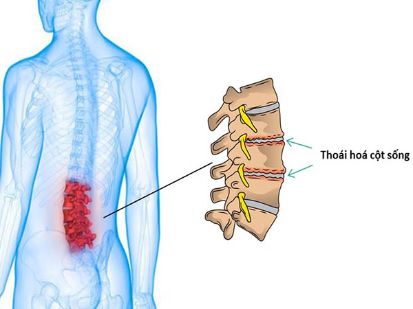 Thoái hoá cột sống là gì? Nguyên nhân, triệu chứng, cách điều trị