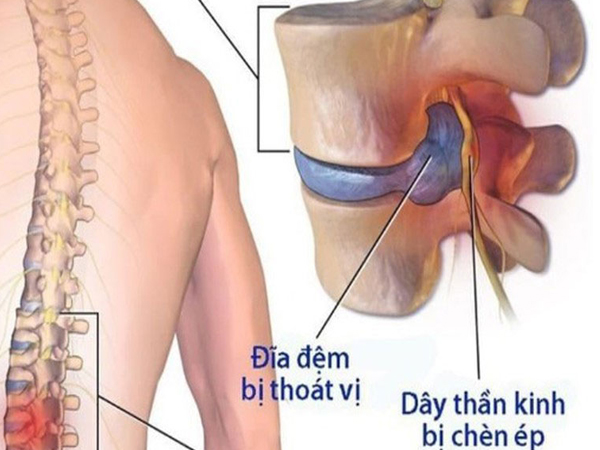 Bệnh thoát vị đĩa đệm: nguyên nhân, biểu hiện và cách điều trị