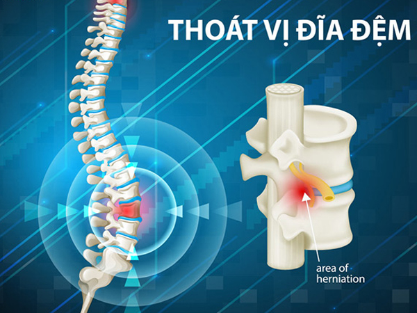 Bệnh thoát vị đĩa đệm: nguyên nhân, biểu hiện và cách điều trị