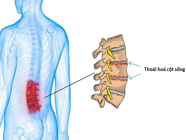 Các bài tập thể dục thoái hoá cột sống lưng đơn giản, hiệu quả